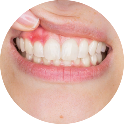 Gengive Studio Dentistico Calcinato Brescia
