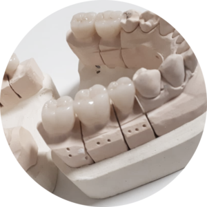 Protesi fissa Protesi fissa Studio Dentistico Brescia