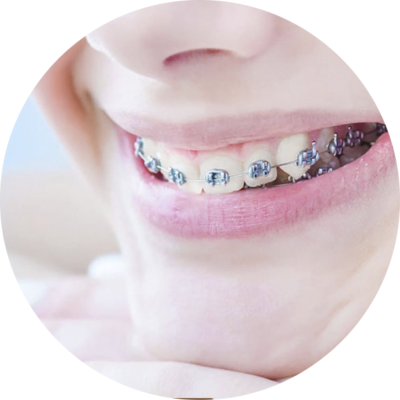 Apparecchio adolescente Apparecchio adolescente studio dentistico Brescia Calcinato